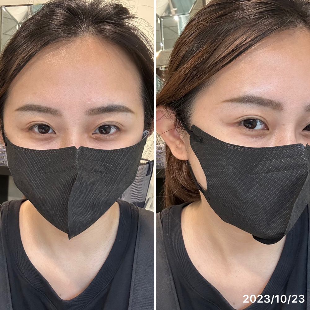 CP值最高!立即有感的醫美!推薦肉毒除皺 - 第12張圖